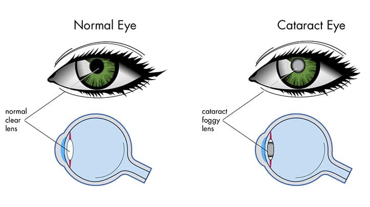 Cataracts