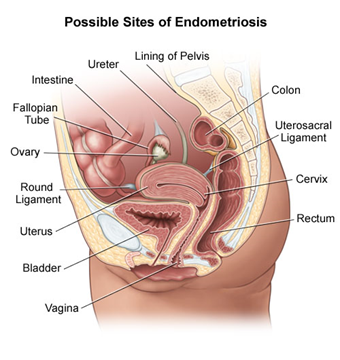 Endometriosis