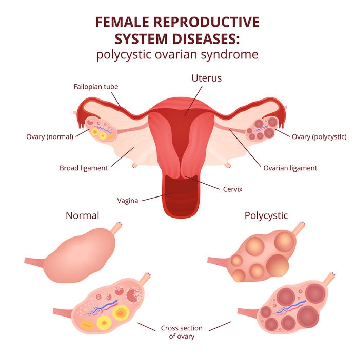 Polycystic Ovary Syndrome (PCOS)